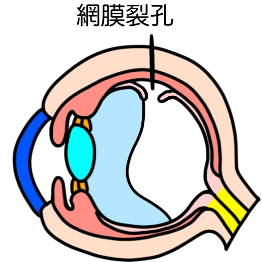 網膜裂孔の症例画像