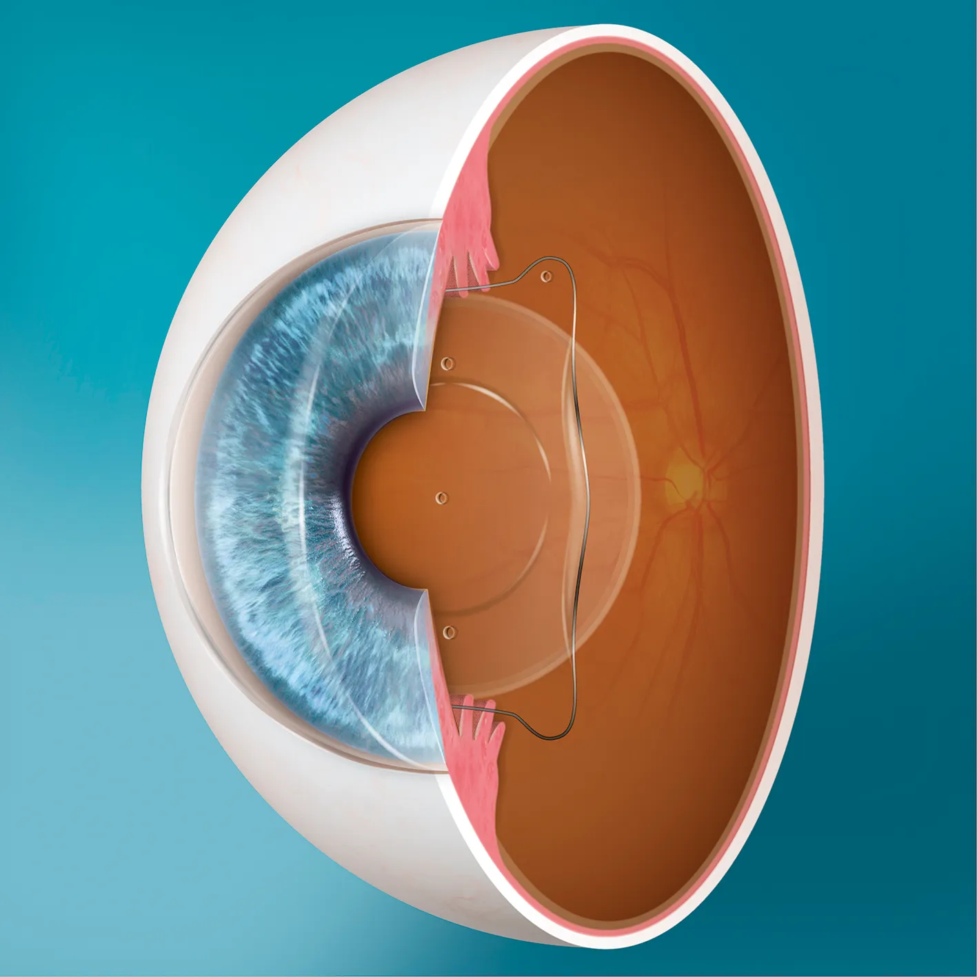 ICL近視矯正手術の説明画像
