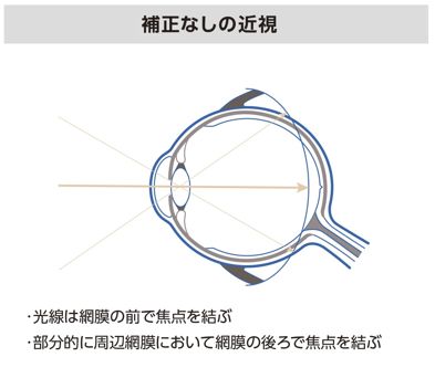 補正なしの近視：光線が網膜の前で焦点を結ぶ