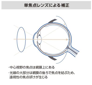 単焦点レンズによる補正：中心視野の焦点は網膜上にあるが、周辺は網膜の後ろで焦点を結ぶ