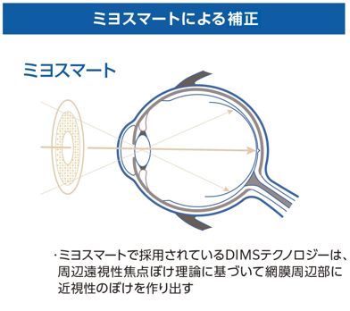 ミヨスマートによる補正：DIMSテクノロジーで網膜周辺部に近視性のぼけを作り出す