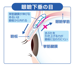 眼瞼下垂の目：挙筋腱膜が伸びる・瞼板から外れることで、まぶたを引き上げる力が瞼板に伝わりにくい状態